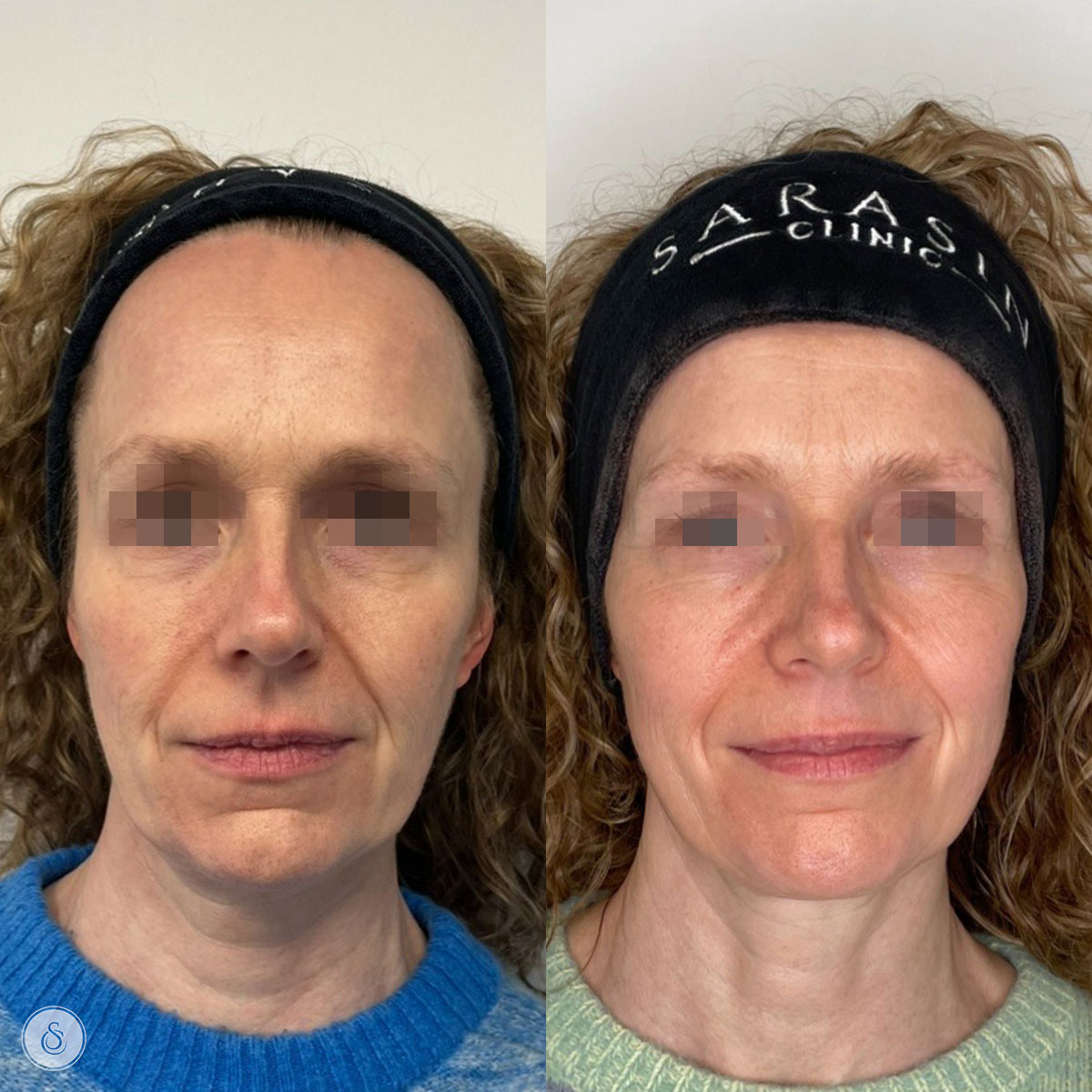 hiemt vrouw voor en na frontaal