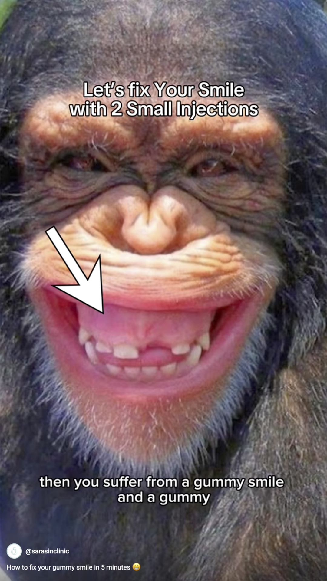 Sarasin_video_How-to-fix-your-gummy-smile-in-5-minutes Sarasin video How to fix your gummy smile in 5 minutes
