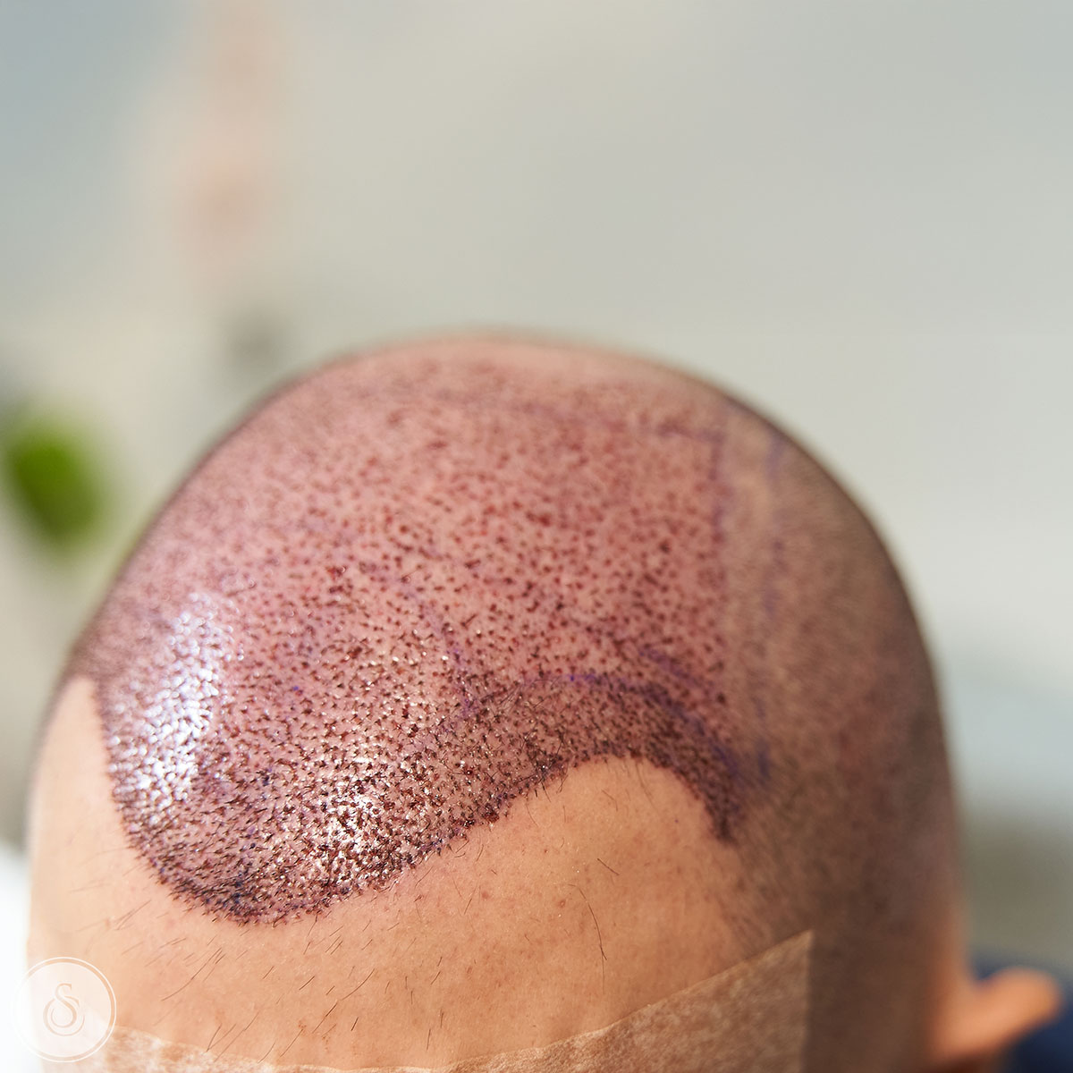 haarimplantatie man