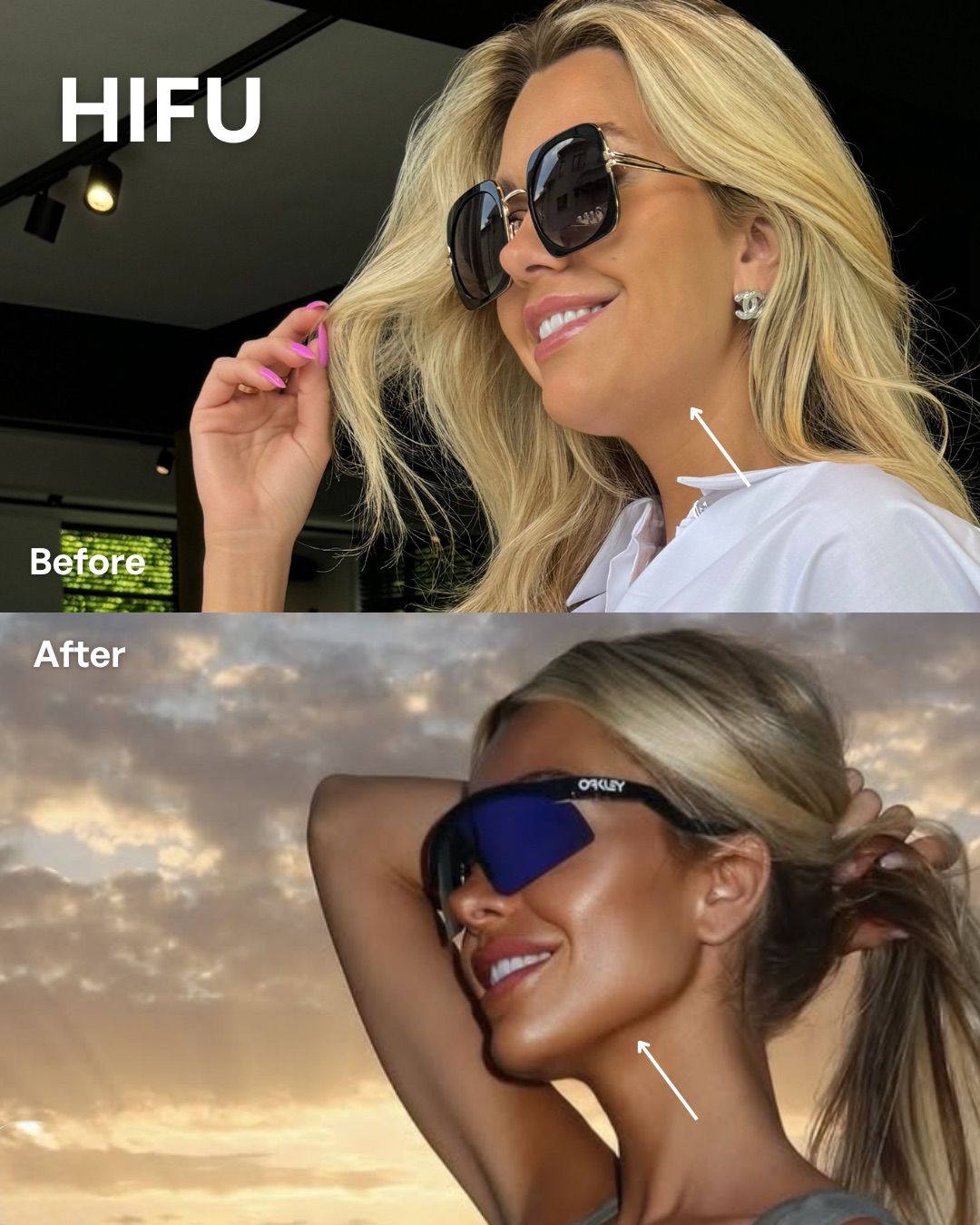 Instagram Feed SB – 2 Hifu jonge vrouw kaaklijn voor en na