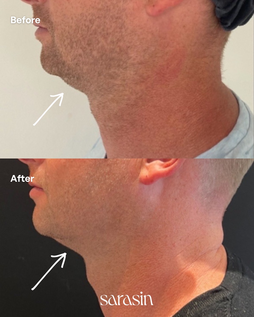 hifu man kin afslanken voor en na profiel