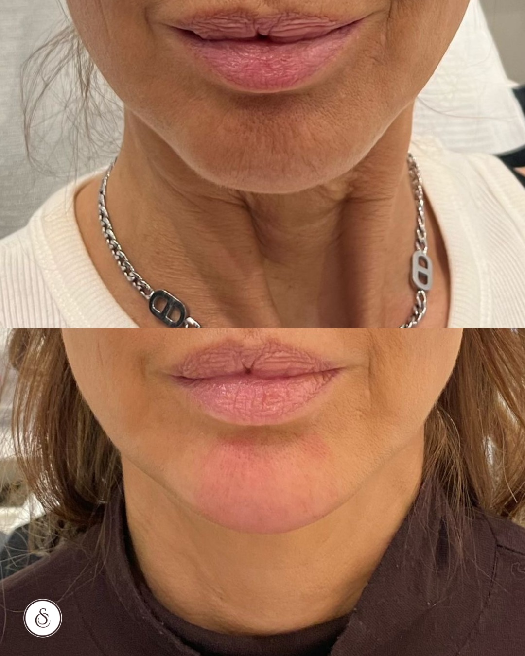 kin botox, kinfiller