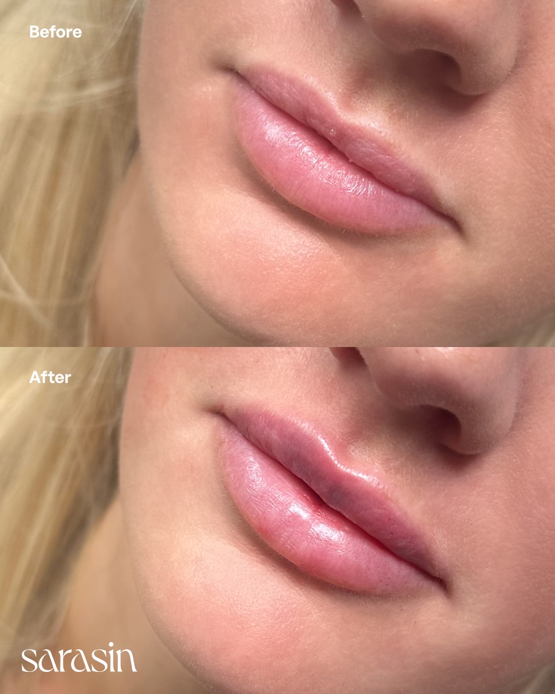 lipfiller voor en na jonge vrouw