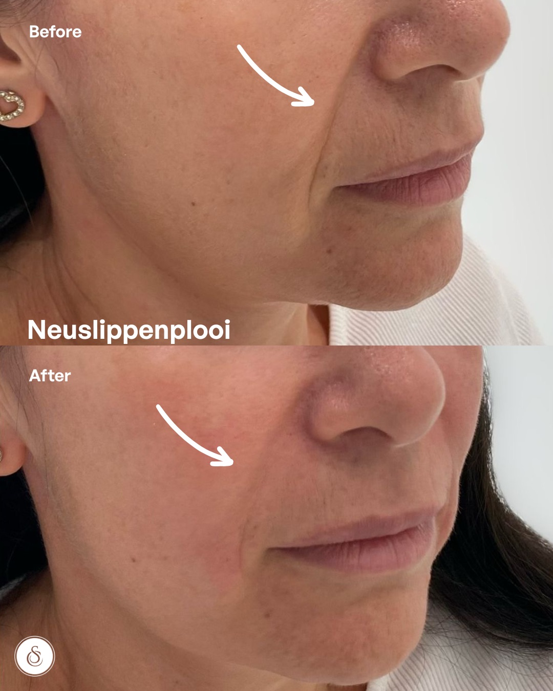 neuslippenplooi filler voor en na