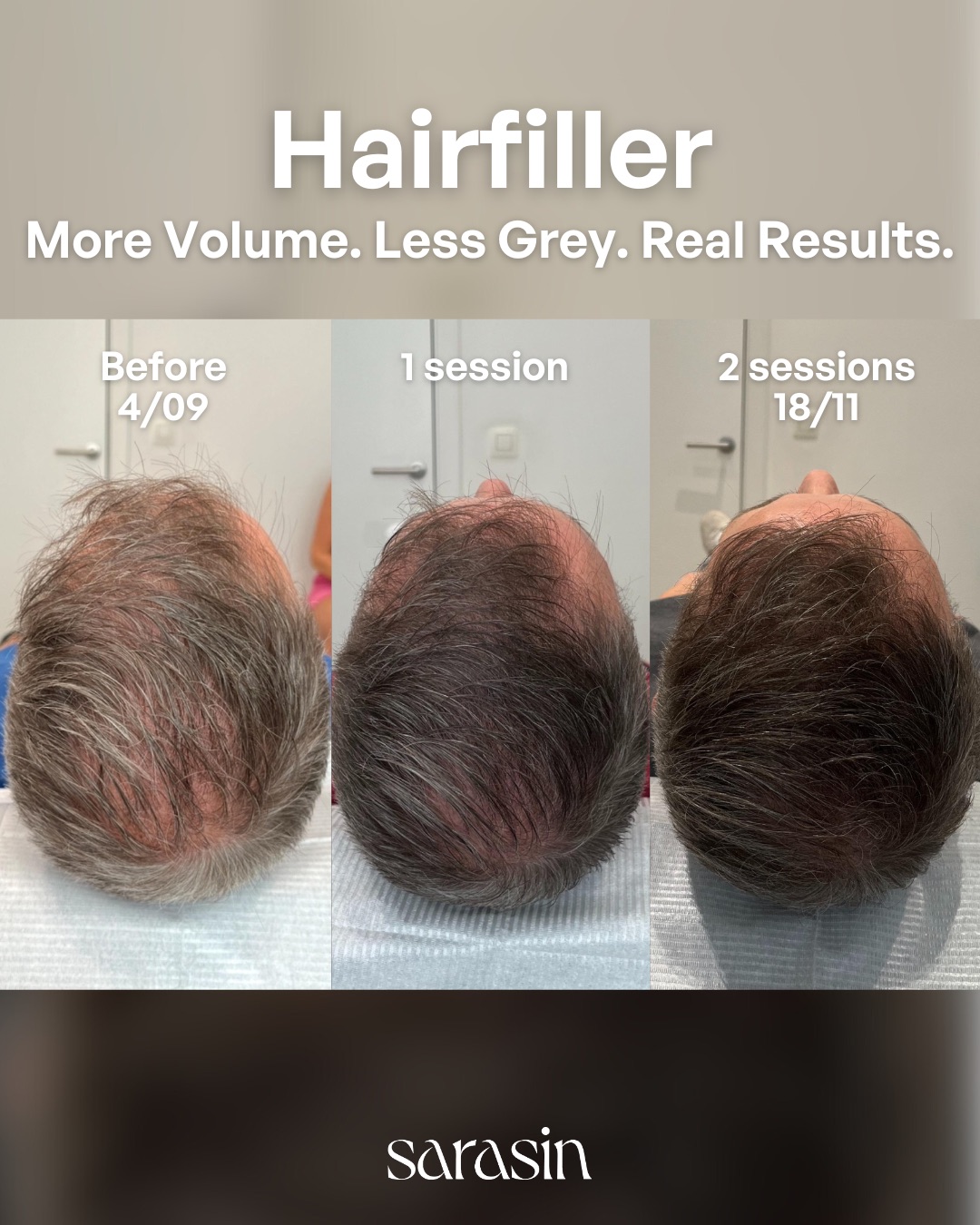 hairfiller man voor - tijdens en na 2 sessies