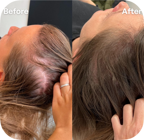 Haarfiller voor en na resultaten sarasin clinic